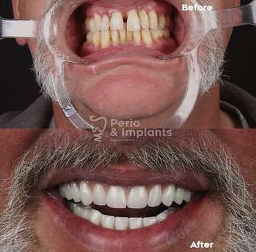 Slider image (6) Perio & Implants Tijuana